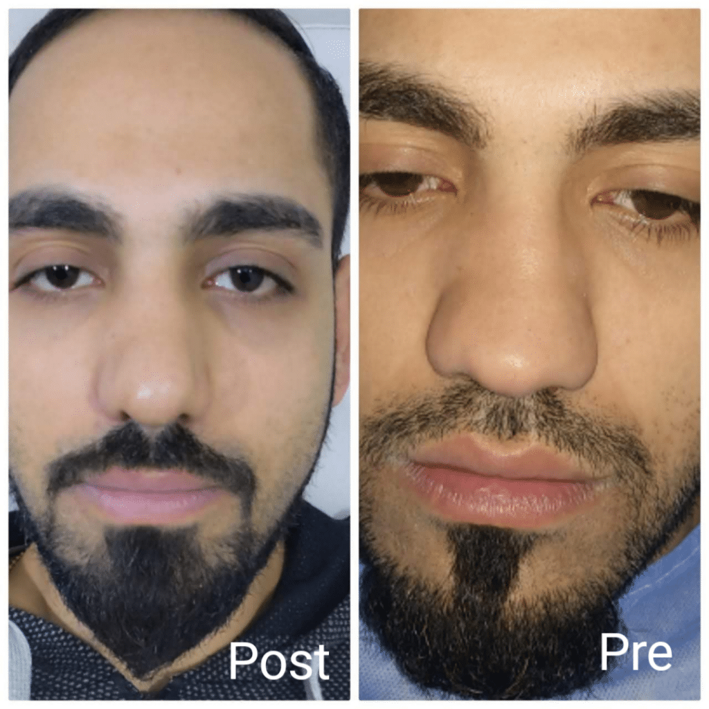 تصغير الأنف للرجال